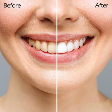 Set di sbiancamento dei denti con gel sbiancante da 15 x 3 ml con gel sbiancante