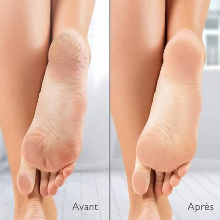 Silk'n Vacupedi - Rimuovi-calli elettrico con aspirazione integrata e 2 lime incluse