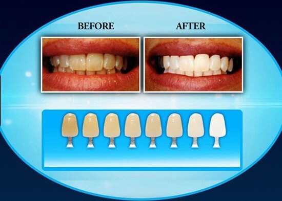 DISPOSITIVO PROFESSIONALE SBIANCANTE A LED DENTI DENTAL WHITE RX SORRISO SUPER Salute e cura della persona/Igiene dentale/Sbiancanti denti/Kit per sbiancamento denti Trade Shop italia - Napoli, Commerciovirtuoso.it